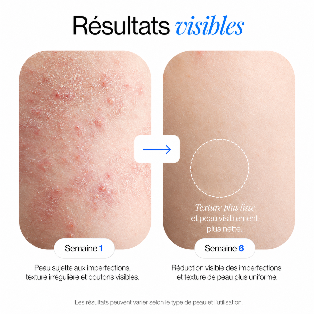 Gel douche à 1 % d'acide salicylique